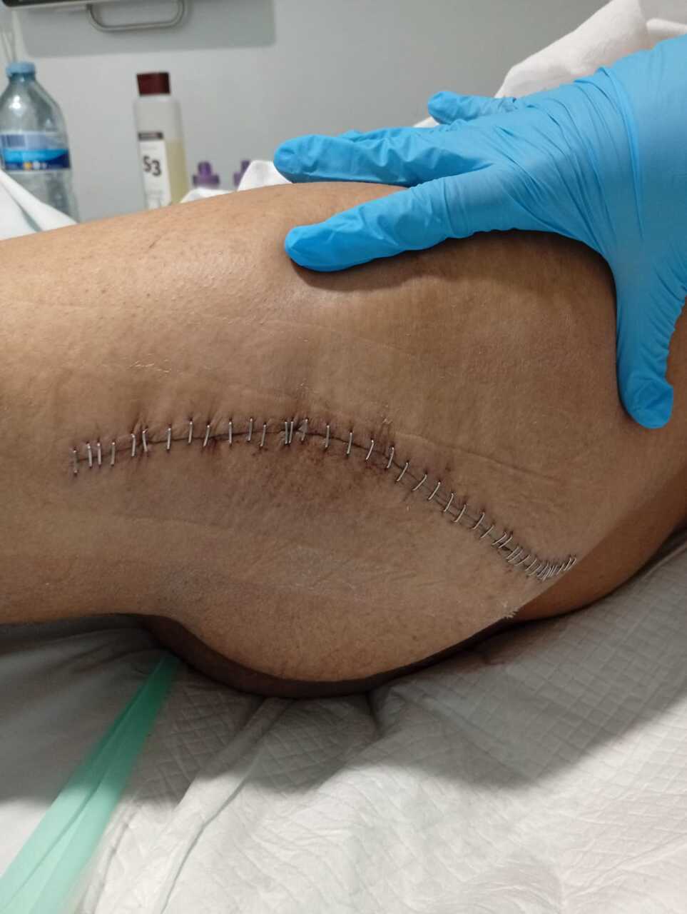 Heridas sufridas por el atropellado